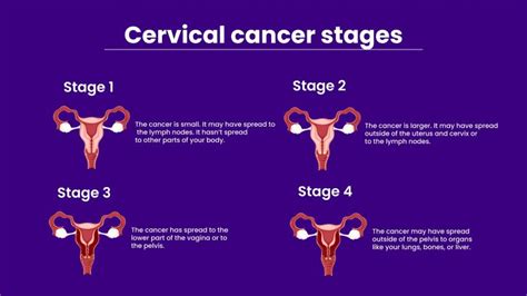 What Are The Main Causes Of Cervical Cancer